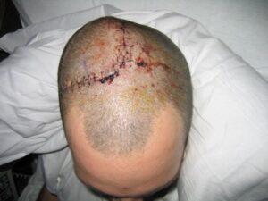 2nd brain surgery 2005